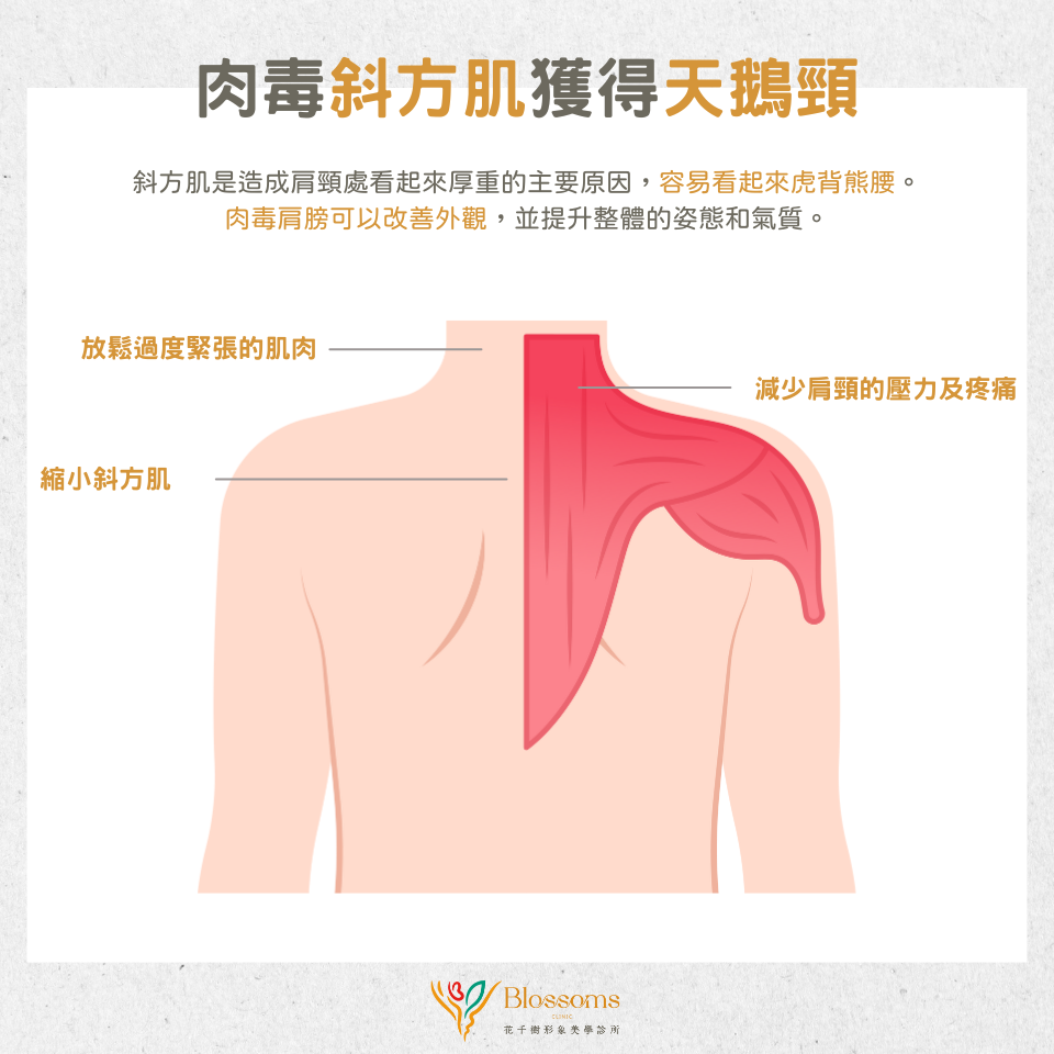 肉毒斜方肌