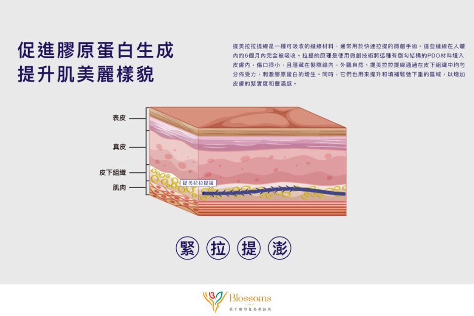 美特拉埋線效果自然