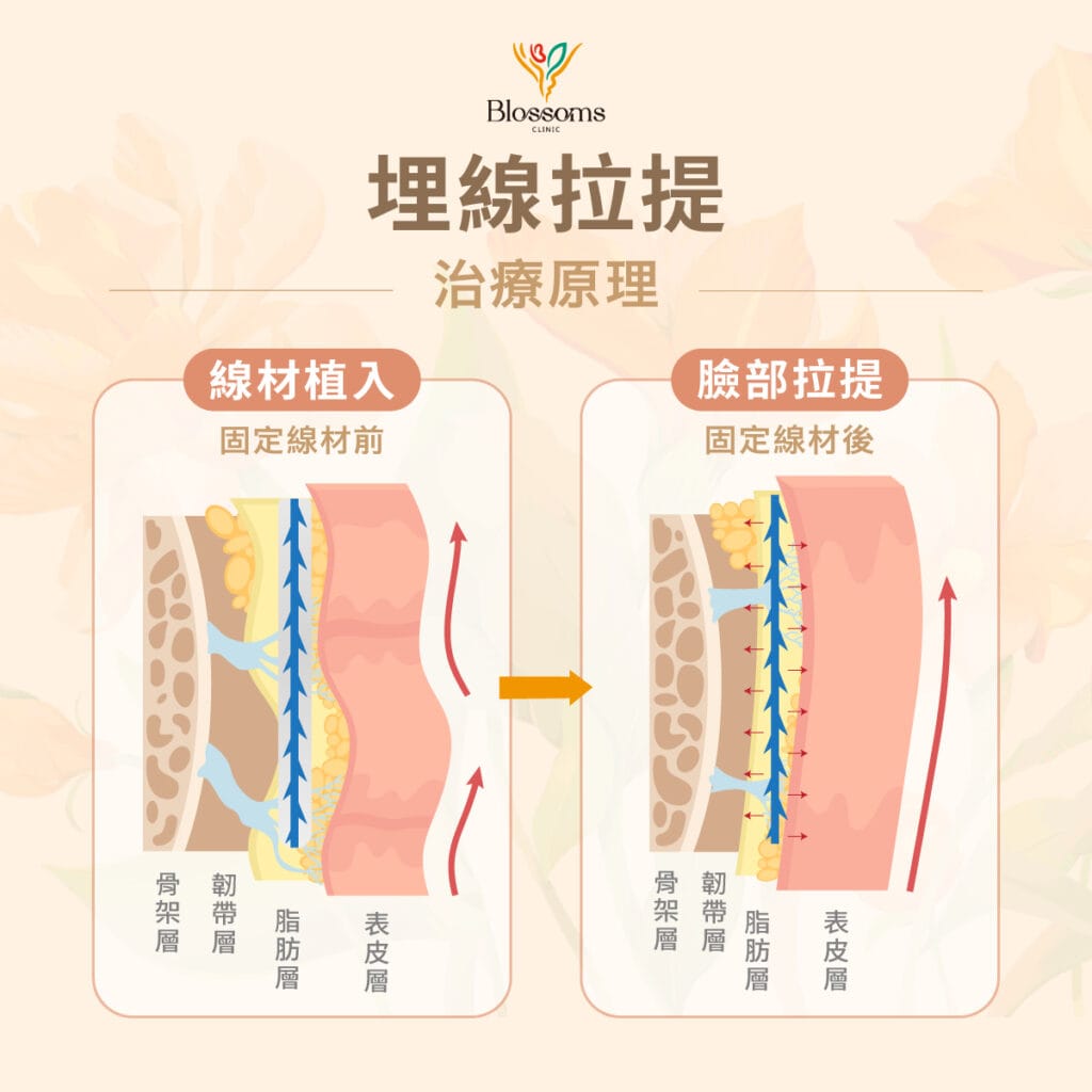 電音波無感後的B計畫：埋線拉提何時能補位？埋線拉提治療原理圖