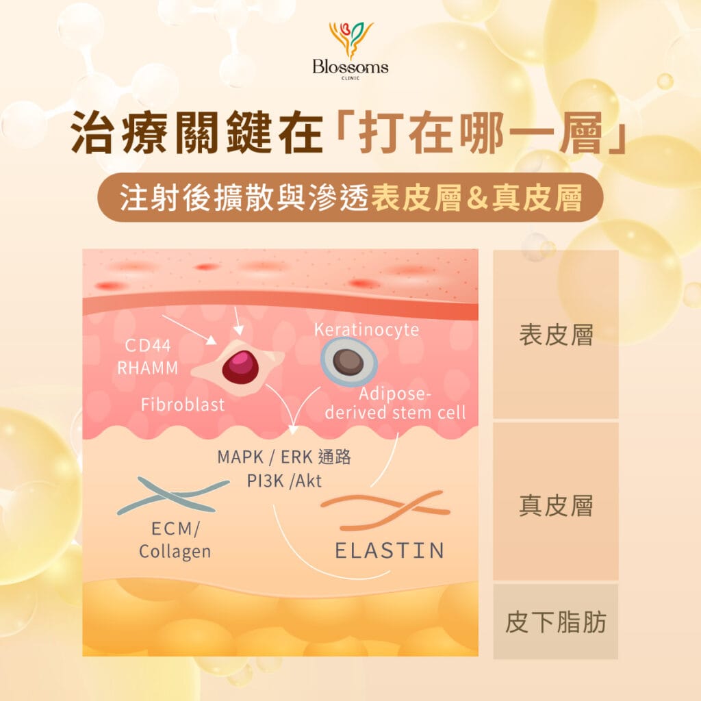 治療關鍵在打在哪一層 注射後擴散與滲透表皮層和真皮層
