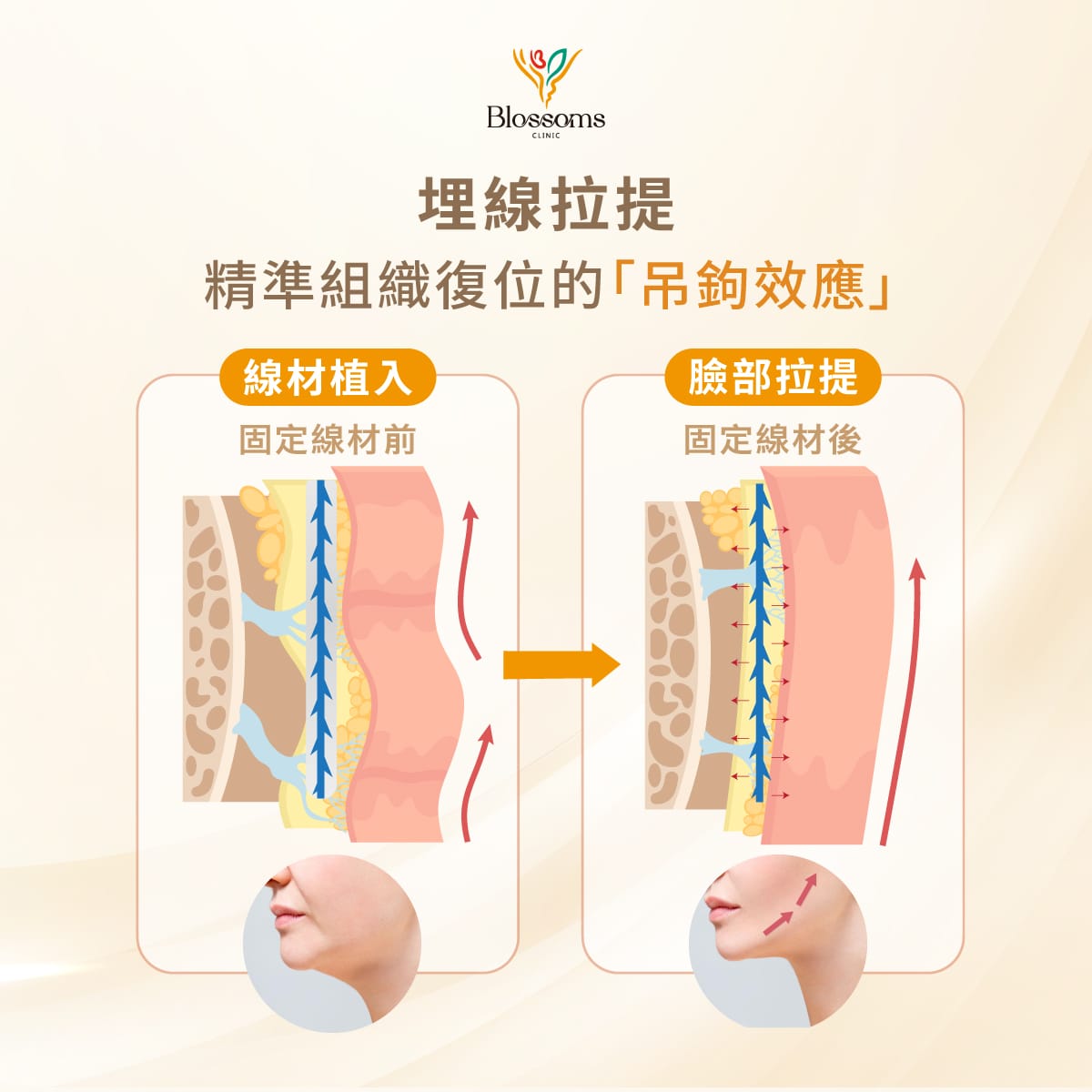 埋線拉提 精準組職的吊鉤效應