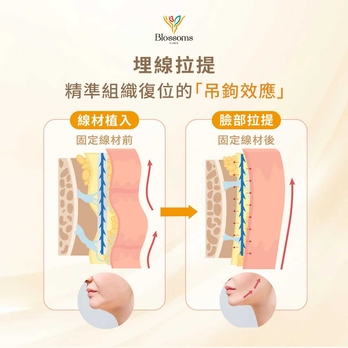 埋線拉提 精準組職的吊鉤效應