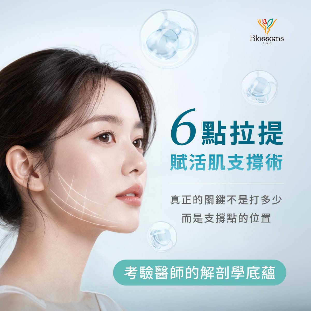 6點拉提 賦活肌支撐術 真正的關鍵不是打多少 而是支撐點的位置