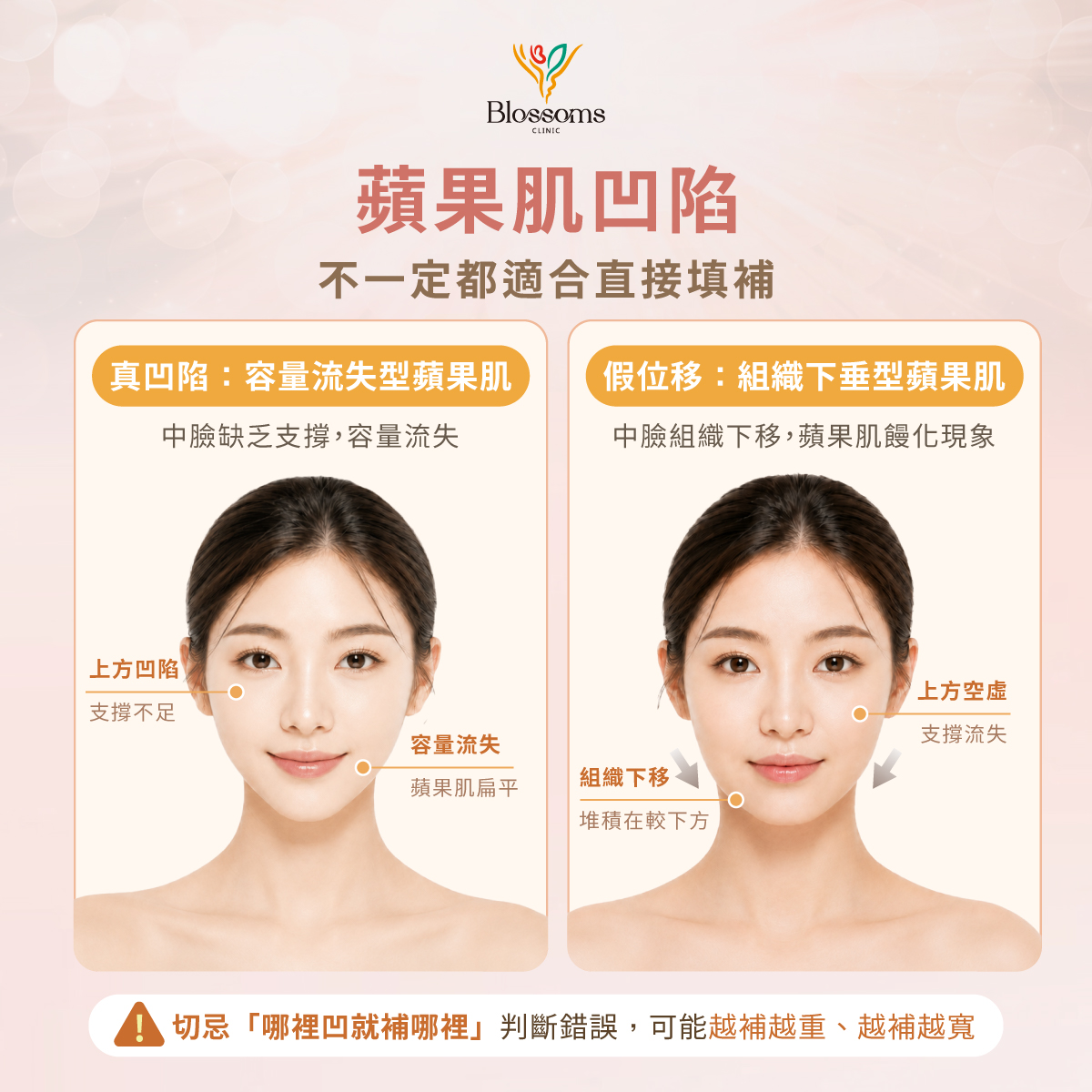 蘋果肌凹陷 不一定都是合直接填補